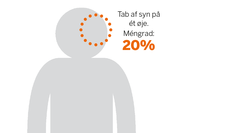 Tab af syn på ét øje giver méngrad på tyve procent